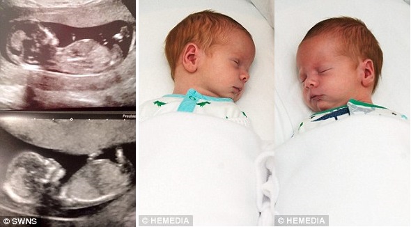 Siêu âm bác sĩ cho biết cặp song sinh phát triển tốt, nhưng đến lúc đỡ đẻ thì ai nấy ngã ngửa khi nhìn cơ thể mỗi bé-2