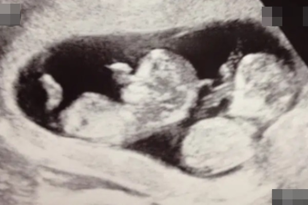 Siêu âm ở tuần thứ 8 phát hiện có 2 tim thai, nhưng đến tuần thứ 12, cặp vợ chồng sửng sốt khi nghe bác sĩ nói câu này-7