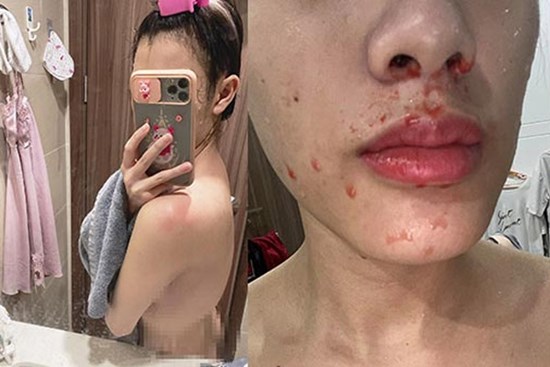 Tắm và gội đầu lúc nửa đêm, cô gái chảy máu mũi gục xỉu trong nhà vệ sinh cầu cứu không ai nghe