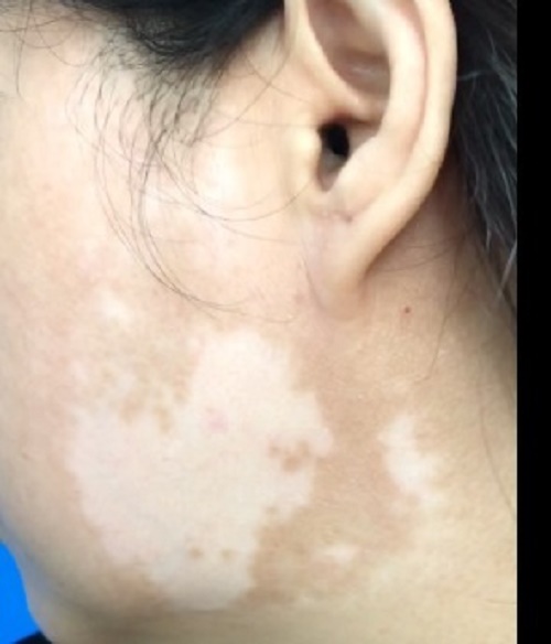 Đắp kem trộn để làm đẹp da, sau một tuần, bệnh nhân nữ bị tổn thương giống bạch biến-2