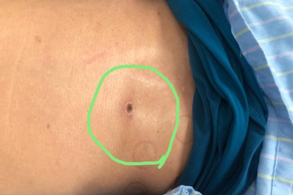 Bé 4 tuổi bị suy đa tạng vì ăn 1 thanh mía mua ven đường: Bác sĩ cảnh báo loại mía tuyệt đối không đụng tới-3