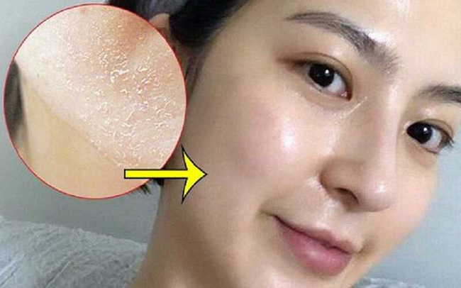 Muốn peel da để làm đẹp cuối năm, chị em cần nắm rõ 3 nguyên tắc, mọi người càng không nên peel da tại nhà-1