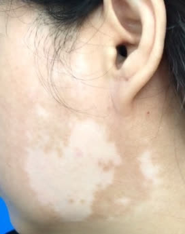 Mặt loang lổ sau khi bôi kem trộn làm đẹp-1