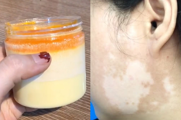 Dùng kem trộn mua trên mạng về bôi, 1 ngày sau cô gái 28 tuổi bị lở loét, chảy dịch, sưng phù mặt-4