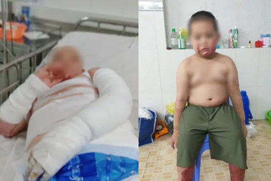 Vụ cha đóng cửa nhà châm lửa đốt khiến 2 con bỏng nặng, bản thân tử vong tại TP.HCM: Người mẹ bị sốc tâm lý, lúc tỉnh lúc mê