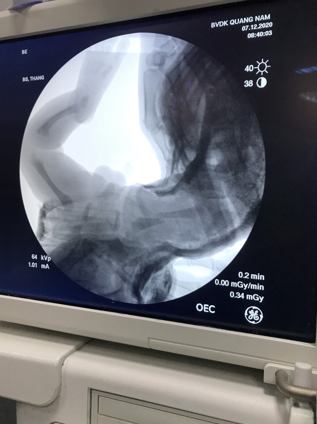 Bệnh viện Đa khoa Quảng Nam báo cáo việc bé trai gãy chân khi sinh mổ-1