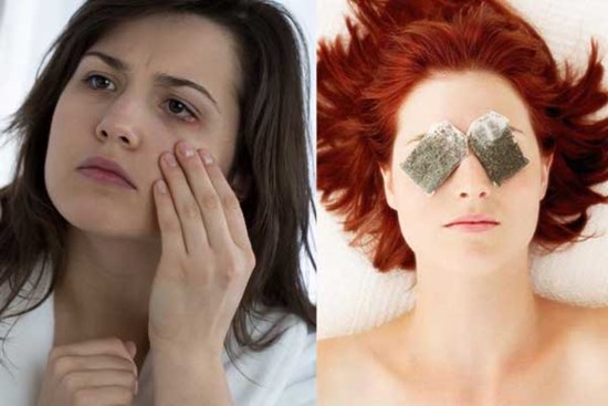 Lẹo mắt bỗng dưng xuất hiện khiến bạn vừa khó chịu vừa mất tự tin, làm thế nào để chúng sớm biến mất?