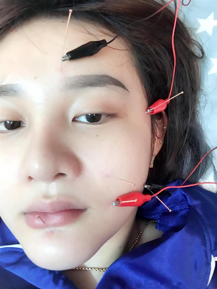 Cố chấp tắm gội lúc 12h khuya, cô gái hoảng loạn thấy máu mũi trào chảy, lo sợ tái diễn triệu chứng liệt nửa cơ mặt-3