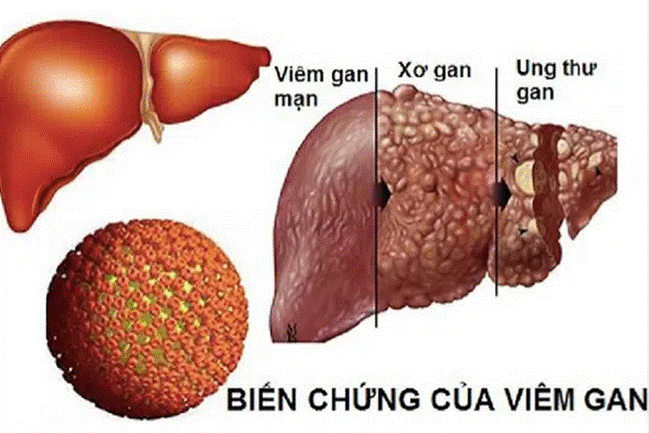 Chàng trai trẻ đau bụng đột ngột, đi khám thì hốt hoảng thấy chỉ số chức năng gan vượt 200 lần, nguyên nhân hóa ra là từ người vợ-3