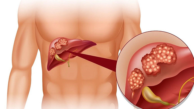 Chàng trai trẻ đau bụng đột ngột, đi khám thì hốt hoảng thấy chỉ số chức năng gan vượt 200 lần, nguyên nhân hóa ra là từ người vợ-4