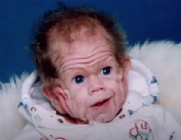 Chào đời với làn da nhăn nheo như một ông già, bé trai khiến bố mẹ sốc nặng, nhiều năm sau ai cũng choáng khi nhìn thấy hình hài đứa trẻ-2