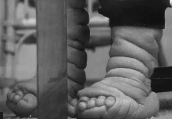 Chào đời với làn da nhăn nheo như một ông già, bé trai khiến bố mẹ sốc nặng, nhiều năm sau ai cũng choáng khi nhìn thấy hình hài đứa trẻ-6