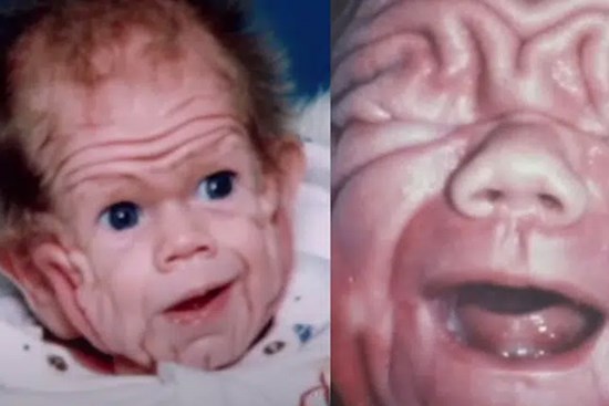 Chào đời với làn da nhăn nheo như một ông già, bé trai khiến bố mẹ sốc nặng, nhiều năm sau ai cũng choáng khi nhìn thấy hình hài đứa trẻ