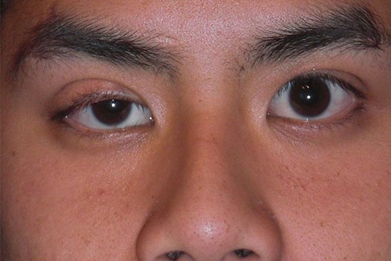 Căn bệnh chết người sau hiện tượng sụp mí mắt