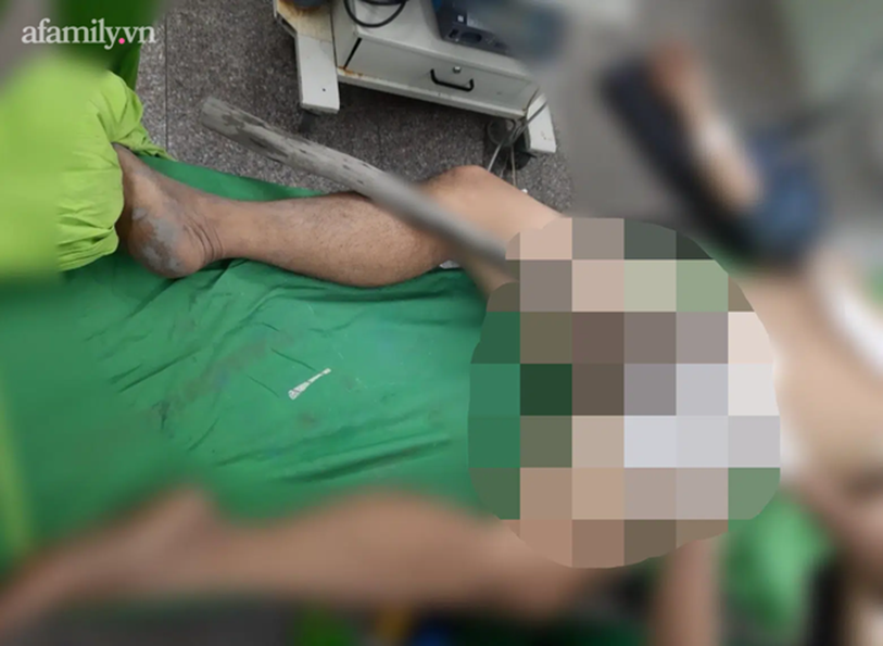 Kinh hoàng: Chồng đang tắm gặp tai nạn bị cây gỗ đâm xuyên từ mông lên bụng, vợ hốt hoảng gọi 15 người đến cứu-1