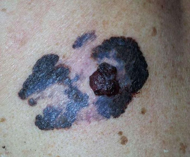 Ung thư không khủng khiếp, điều khủng khiếp là tế bào ung thư sẽ di căn, cơ thể xuất hiện 4 hiện tượng này, hãy đi khám ngay lập tức-2