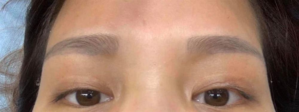 Cô gái đăng đàn bức xúc vì xóa xăm lông mày để lại vết bầm đỏ, lơ thơ sợi bạc, thẩm mỹ viện chính thức lên tiếng-1