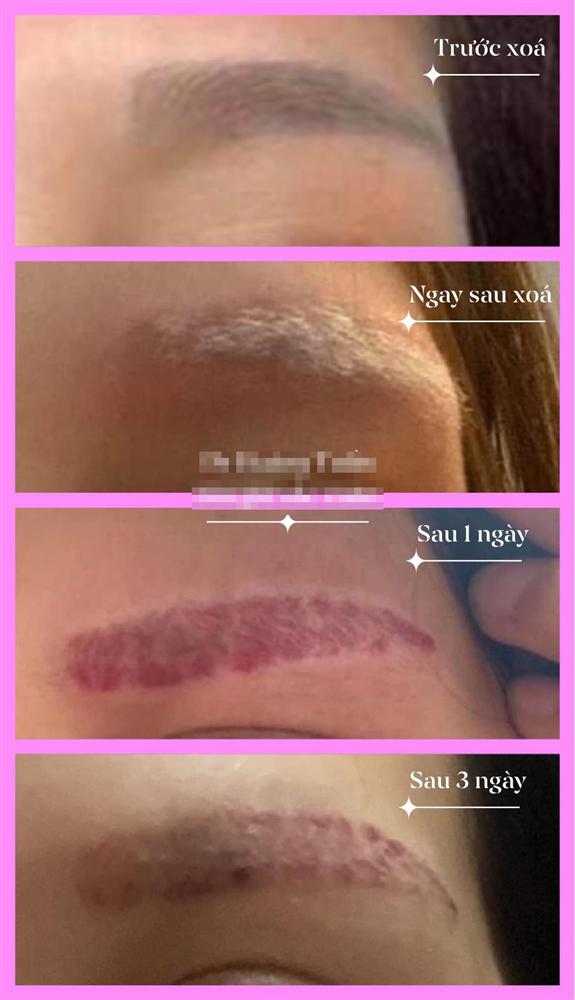 Cô gái đăng đàn bức xúc vì xóa xăm lông mày để lại vết bầm đỏ, lơ thơ sợi bạc, thẩm mỹ viện chính thức lên tiếng-6