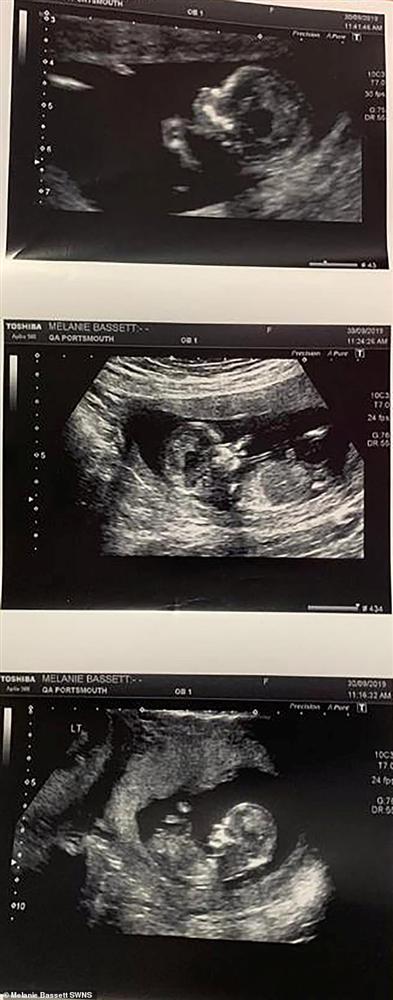 Siêu âm ở tuần thứ 8 phát hiện có 2 tim thai, nhưng đến tuần thứ 12, cặp vợ chồng sửng sốt khi nghe bác sĩ nói câu này-1