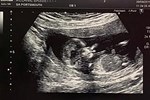Siêu âm ở tuần 12 thấy hình ảnh thai nhi đeo khẩu trang”, chỉ vài ngày sau bà mẹ nhận được tin dữ-4