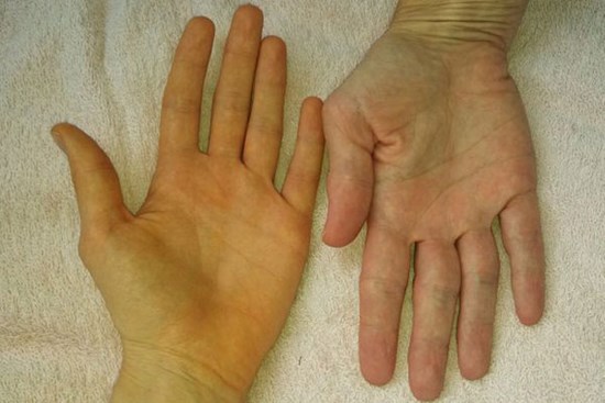 Soi tay chân cũng có thể nhận biết được 5 biểu hiện cảnh báo bạn có nguy cơ mắc ung thư hay không
