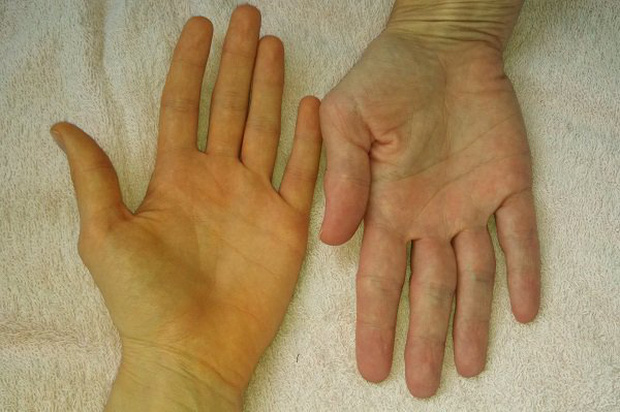 Soi tay chân cũng có thể nhận biết được 5 biểu hiện cảnh báo bạn có nguy cơ mắc ung thư hay không-1