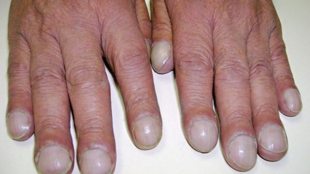 Soi tay chân cũng có thể nhận biết được 5 biểu hiện cảnh báo bạn có nguy cơ mắc ung thư hay không-2