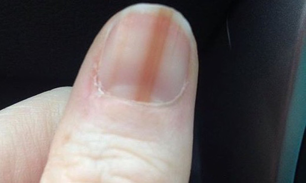 Soi tay chân cũng có thể nhận biết được 5 biểu hiện cảnh báo bạn có nguy cơ mắc ung thư hay không-5