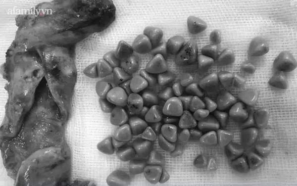 Đau bụng dữ dội nhưng chủ quan tự mua thuốc uống, người phụ nữ phát hiện túi mật hóa đá trong bụng kinh hoàng-2