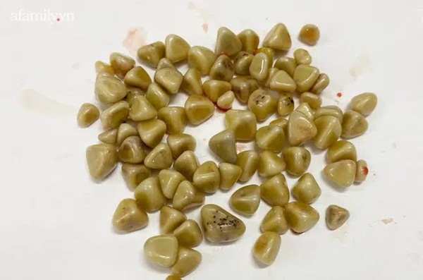 Đau bụng dữ dội nhưng chủ quan tự mua thuốc uống, người phụ nữ phát hiện túi mật hóa đá trong bụng kinh hoàng-3