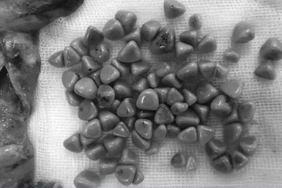 Đau bụng dữ dội nhưng chủ quan tự mua thuốc uống, người phụ nữ phát hiện túi mật