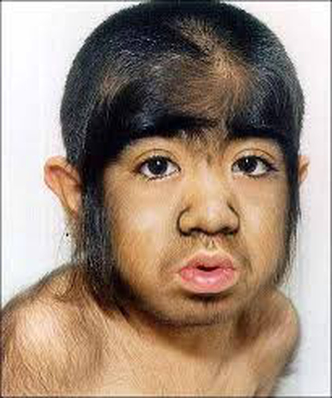 Cậu bé người vượn” sinh ra toàn thân phủ đầy lông bị gia đình ghét bỏ vì xấu xí gây bất ngờ với cuộc sống hiện tại bên bạn gái xinh đẹp-3