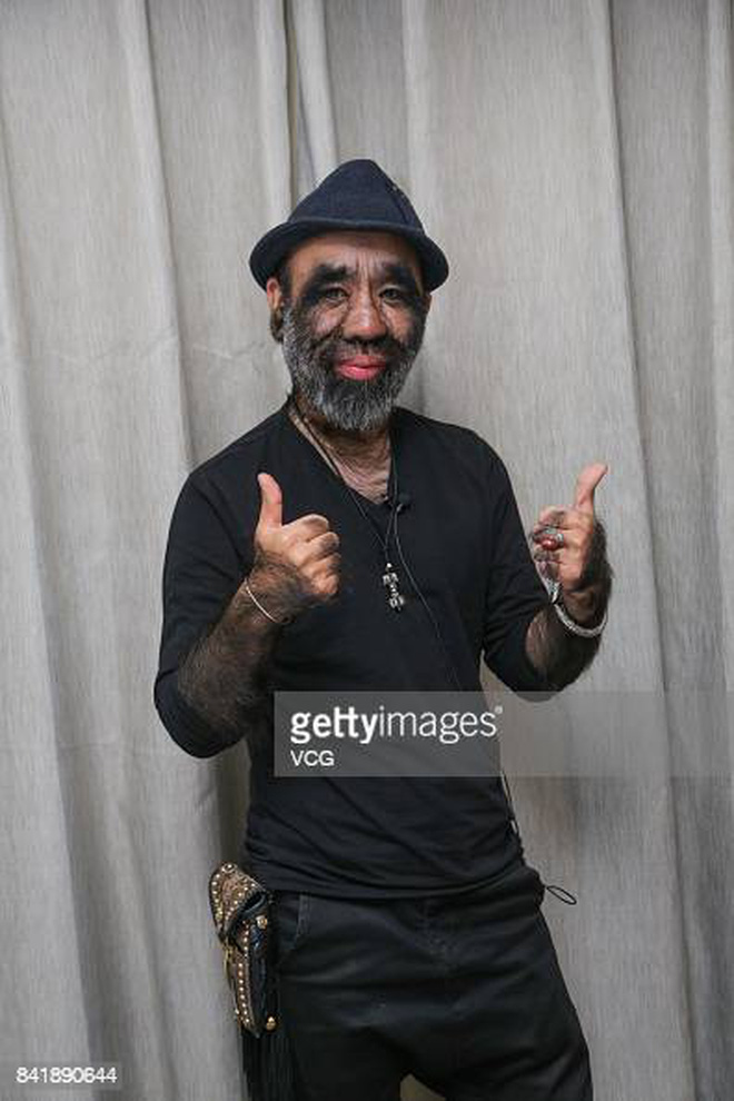 Cậu bé người vượn” sinh ra toàn thân phủ đầy lông bị gia đình ghét bỏ vì xấu xí gây bất ngờ với cuộc sống hiện tại bên bạn gái xinh đẹp-9