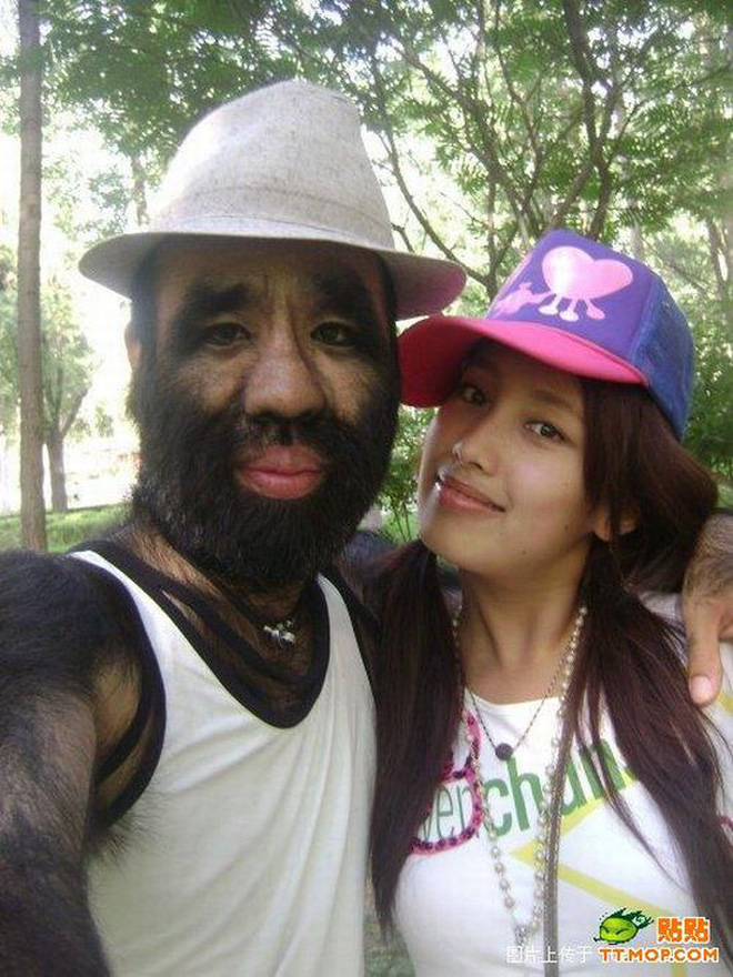 Cậu bé người vượn” sinh ra toàn thân phủ đầy lông bị gia đình ghét bỏ vì xấu xí gây bất ngờ với cuộc sống hiện tại bên bạn gái xinh đẹp-13