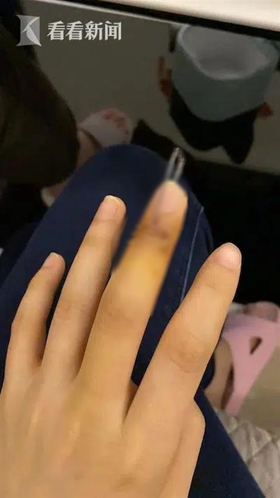 Người phụ nữ đột ngột đứt gân ngón tay khi đang đi vứt rác, nguyên nhân được tiết lộ khiến ai cũng phải tự ngẫm lại bản thân mình-3