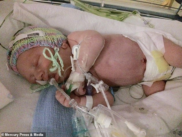 Bất chấp dự đoán chỉ có 5% khả năng sống sót, cậu bé sinh ra với nội tạng nằm ngoài cơ thể đã khiến nhiều người ngỡ ngàng sau 4 năm-4