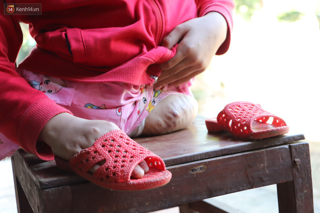 Xót cảnh bé gái 12 tuổi phải nghỉ học, cắt bỏ đôi chân sau trận sốt bại liệt: Tóc con dần rụng hết rồi-8