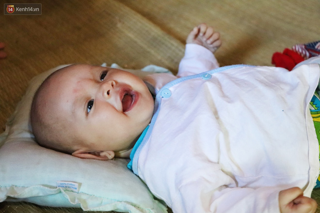 Xót cảnh bé gái 12 tuổi phải nghỉ học, cắt bỏ đôi chân sau trận sốt bại liệt: Tóc con dần rụng hết rồi-12