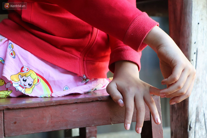 Xót cảnh bé gái 12 tuổi phải nghỉ học, cắt bỏ đôi chân sau trận sốt bại liệt: Tóc con dần rụng hết rồi-15