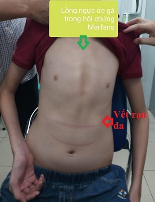 Bé trai 11 tuổi cao 1,8 m-1