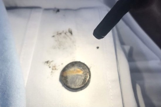 Bé trai bị bỏng thực quản do nuốt pin