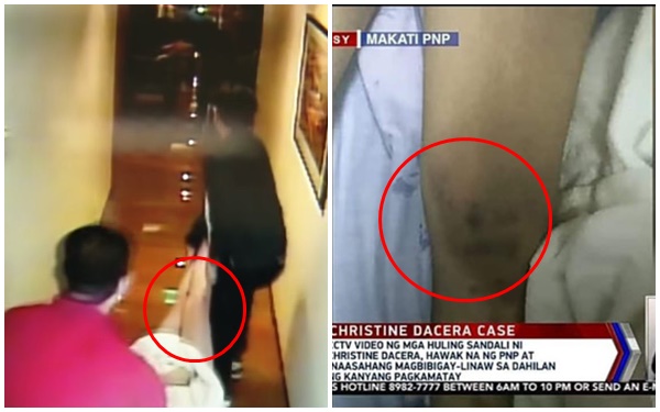 Truyền thông công bố hình ảnh Á hậu Philippines được đưa đi cấp cứu sau khi bất tỉnh, chân nạn nhân không có vết bầm như tư liệu từ cảnh sát-4