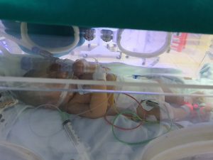 Bé 9 ngày tuổi nguy kịch do bị uốn ván-1