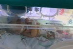 Cứu sống trẻ bị uốn ván nặng do người thân tự dùng tre cắt dây rốn sau khi sinh tại nhà-2