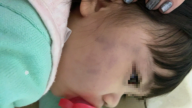 Trẻ không ngủ, nữ giúp việc bạo hành bé tới thâm tím má, nói dối với bố mẹ bé tự ngã dù được trả lương cao, đối đãi hậu hĩnh như người nhà-2