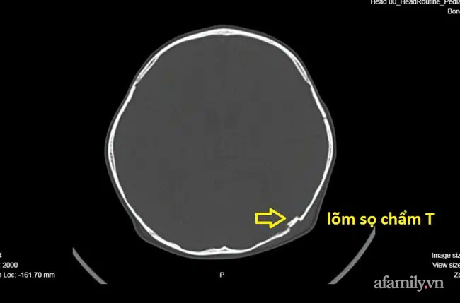 Tai nạn kinh hoàng: Anh lấy xe đạp chở em út quanh xóm rồi bị té, bé trai 2 tuổi lõm sọ não-2