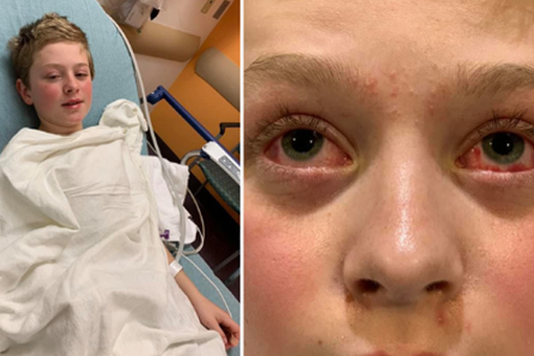 Tấm ảnh cháu bé miền núi phía Bắc bị xuất huyết dưới kết mạc do thời tiết rét lạnh đỏ ngầu cả 2 mắt: BS chuyên khoa Mắt nói sự thật về nguyên nhân-3