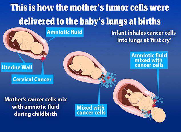 Sốc: 2 trẻ sơ sinh Nhật Bản hít phải tế bào ung thư từ mẹ-1