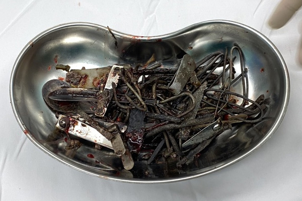 Hơn một kg đinh vít, thìa, lưỡi dao trong bụng bệnh nhân-1