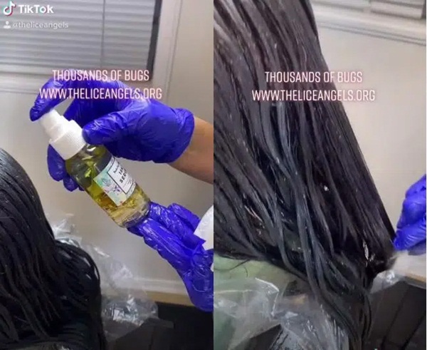 Rùng mình xem cảnh chải đầu của bé gái nhiều chấy chưa từng có, hàng nghìn con chấy lúc nhúc chui ra khỏi tóc chỉ sau 1 lần đưa lược-1